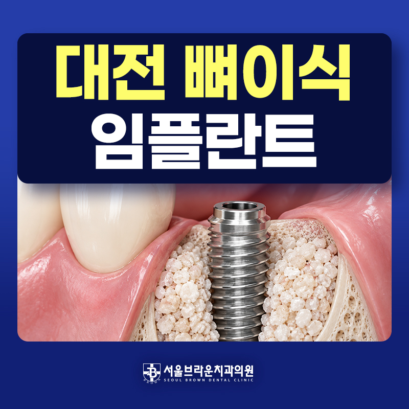 대전 뼈이식 임플란트 치료 정보 안내
